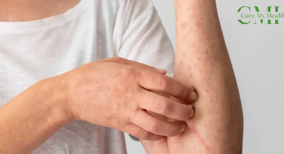 Types of Skin Diseases