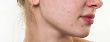 How to get rid of Acne Scars using Home Remedies