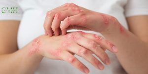 What is Leprosy? 2 symptoms of leprosy