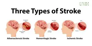  ischemic stroke