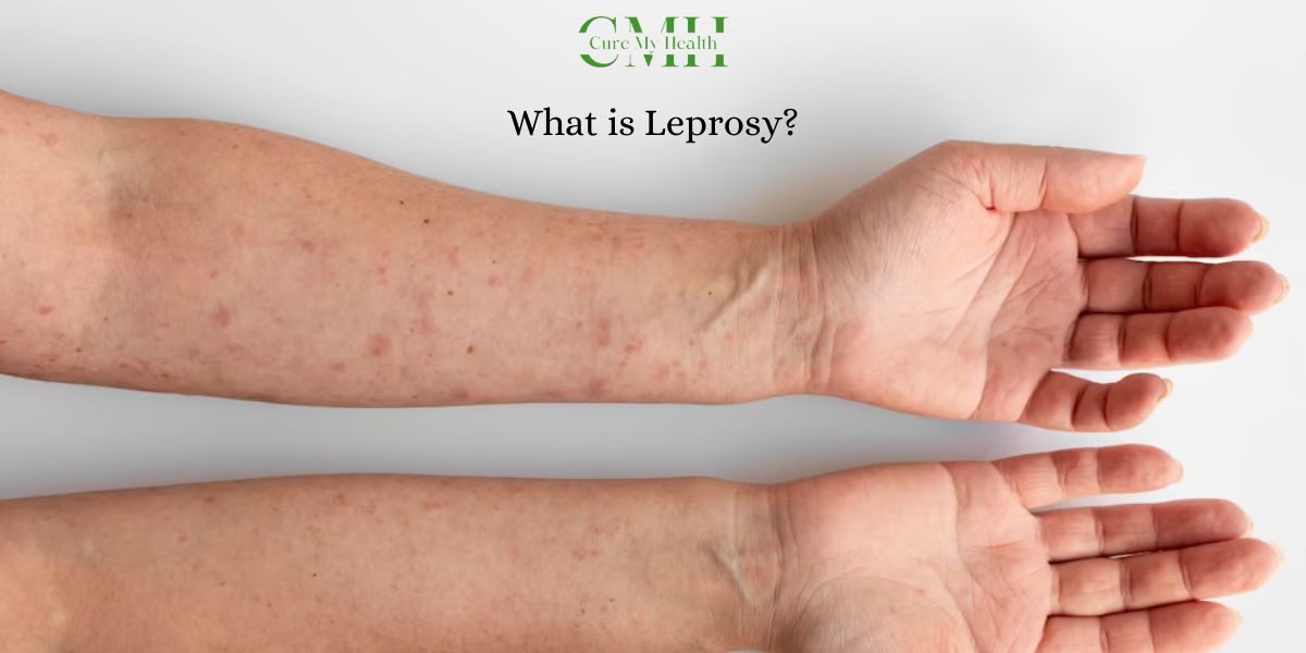 What is Leprosy?
