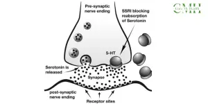 Selective Serotonin Reuptake Inhibitors (SSRI)