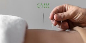 Acupuncture