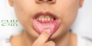 Common Causes of Mouth Ulcers