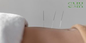 Acupuncture Needles