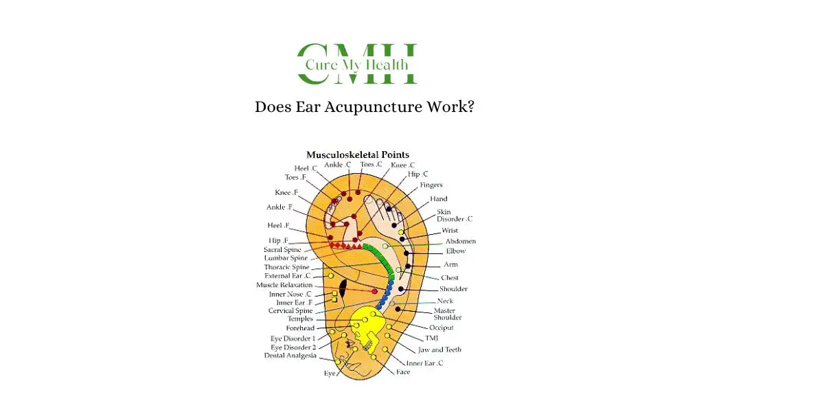 EAR Acupuncture